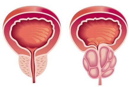 Prostatitis symptoms in men